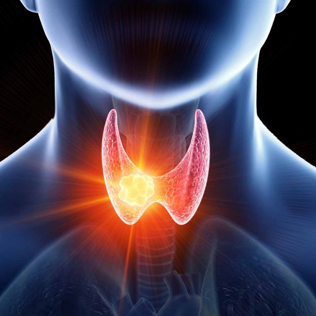 Tiroid Nodülleri